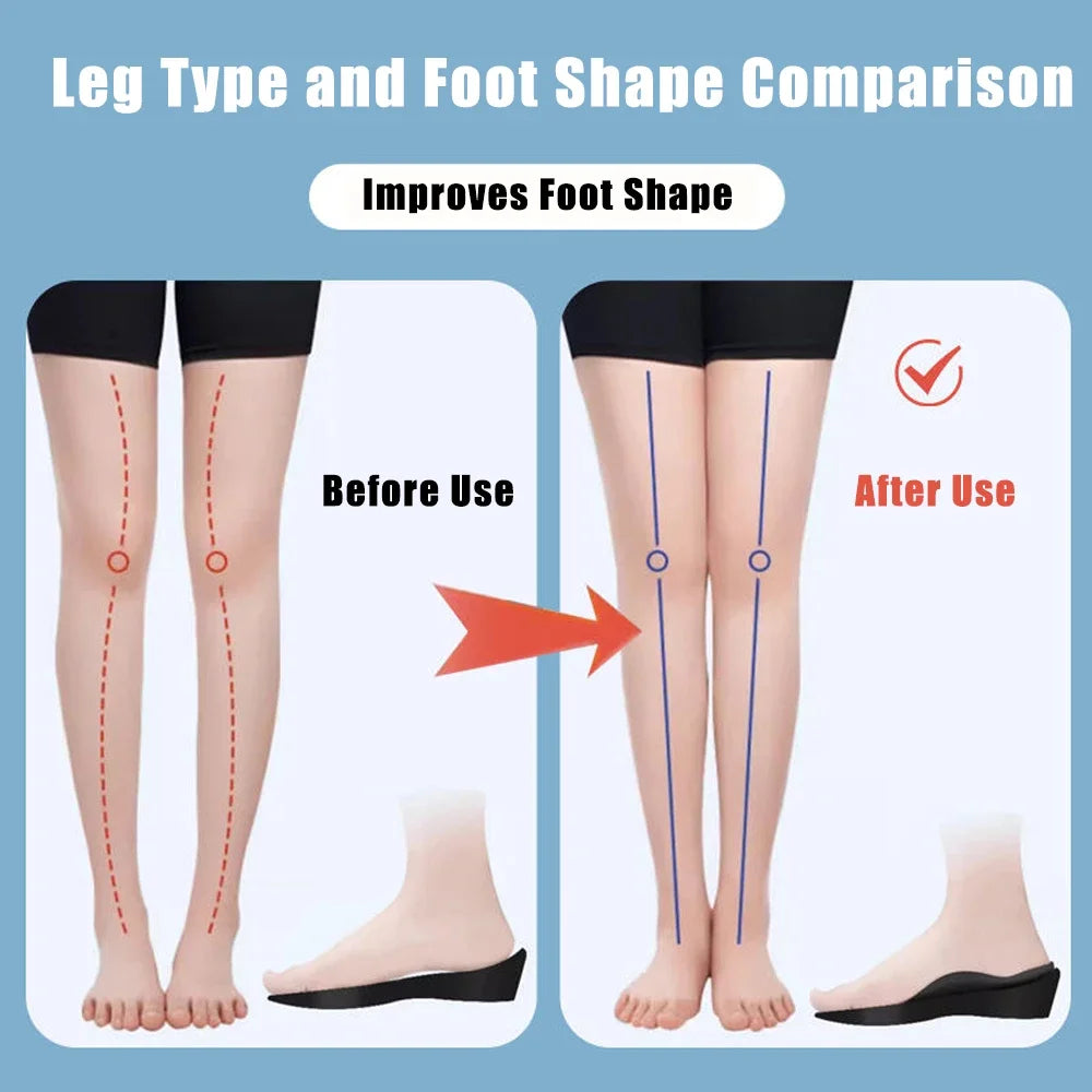 Flat Feet Arch Support Insoles for Shoes Women Men XO-Legs Corrector