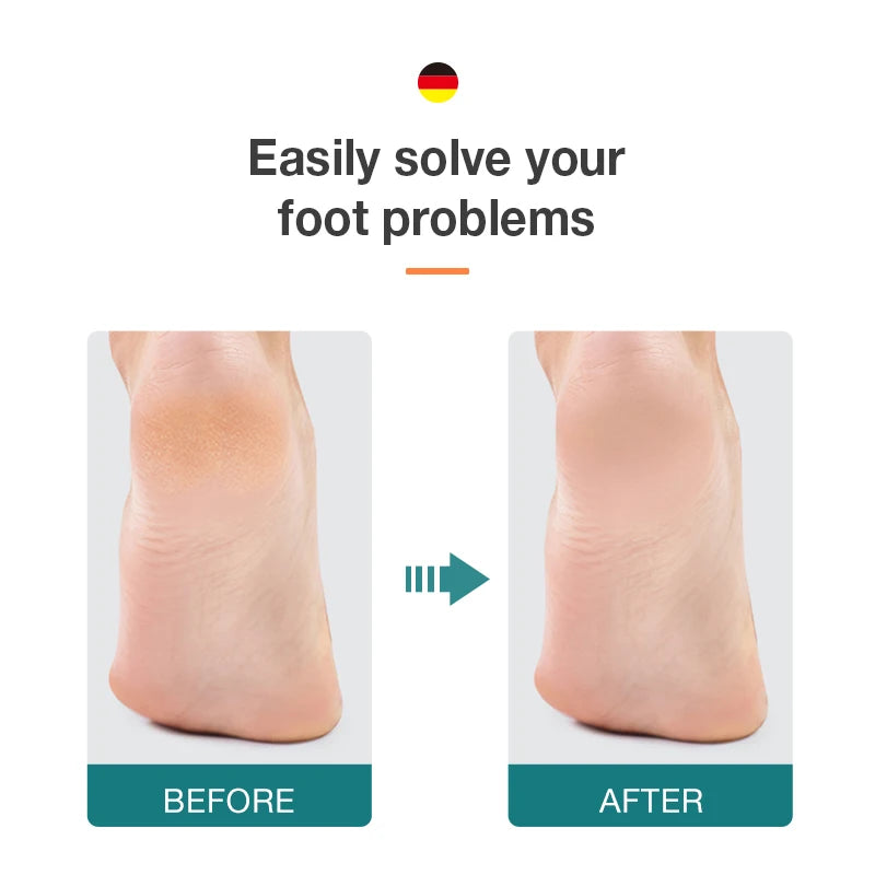 foot care Double Sided Callus Remover
